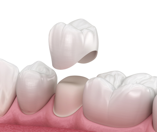  Illustration of a dental crown similar to what our dentist in Norwalk creates